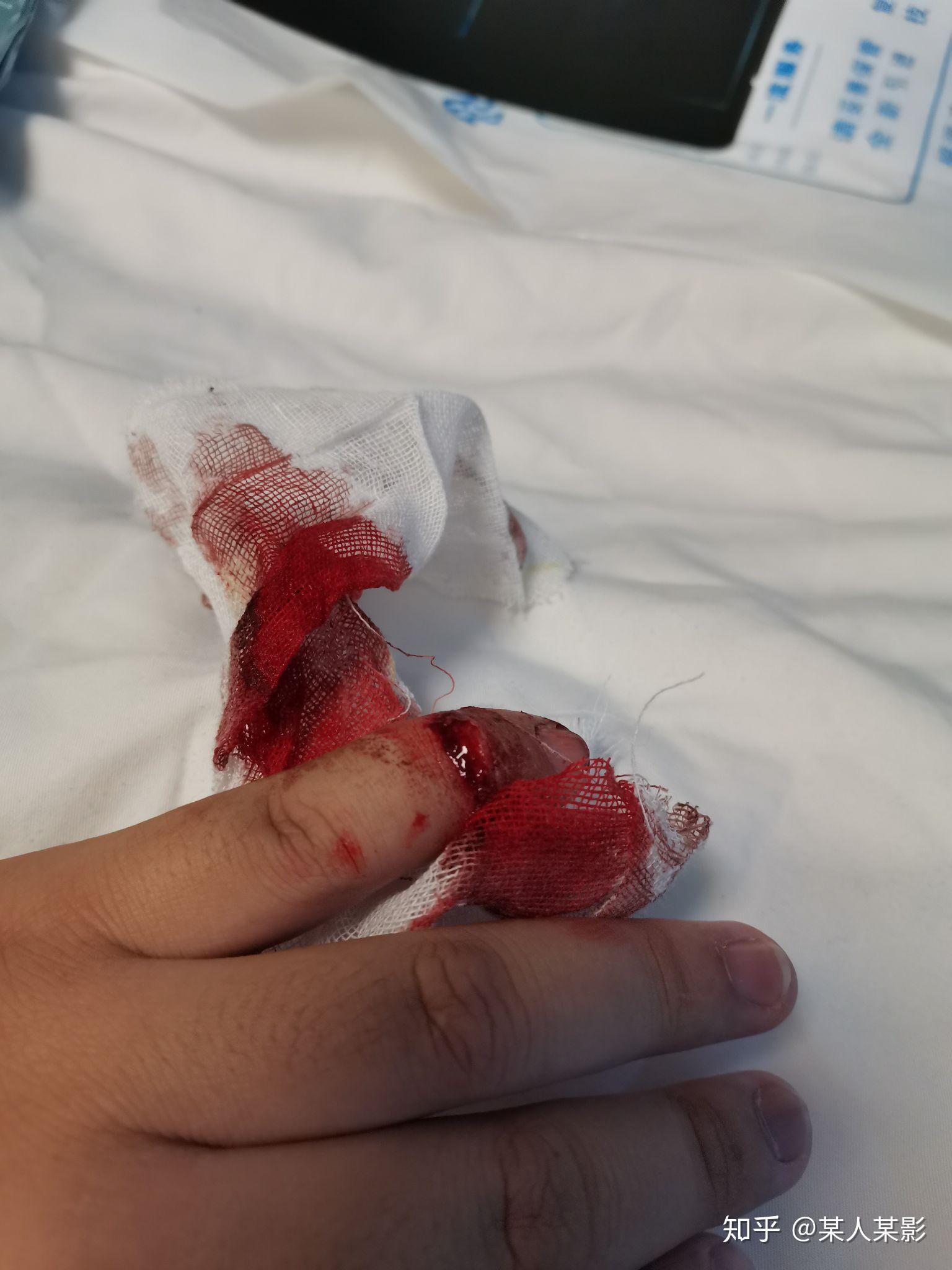 手指切断了还能康复吗? - 知乎