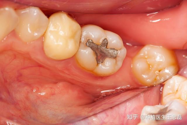 智齿冠周炎伴随急性牙髓炎,牙疼的不行!该怎么处理?牙病不能拖