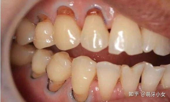 牙齿楔状缺损怎么办?