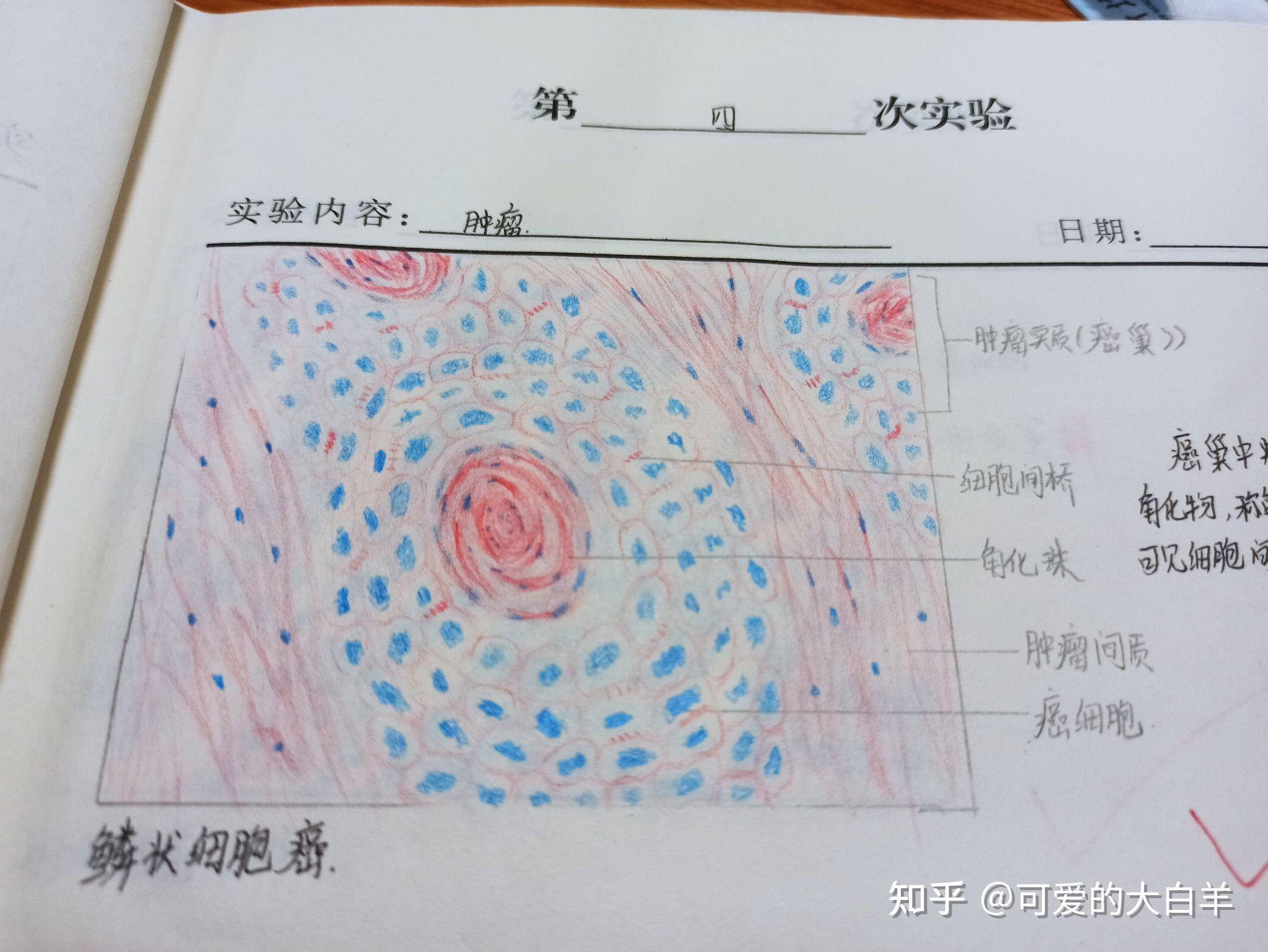 腺癌红蓝铅笔图片