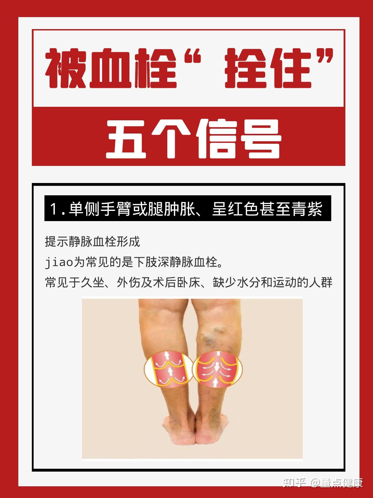 血栓的五个信号! - 知乎