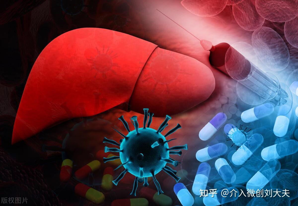 肝硬化患者TIPS术后,肝功能可否再代偿? - 知乎