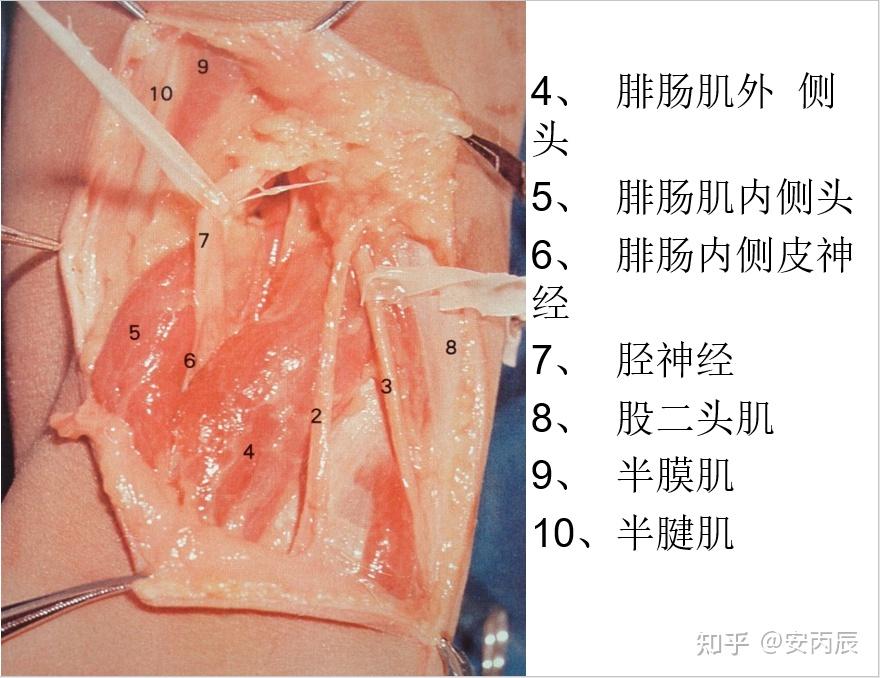 腘窝囊肿手术图谱图片