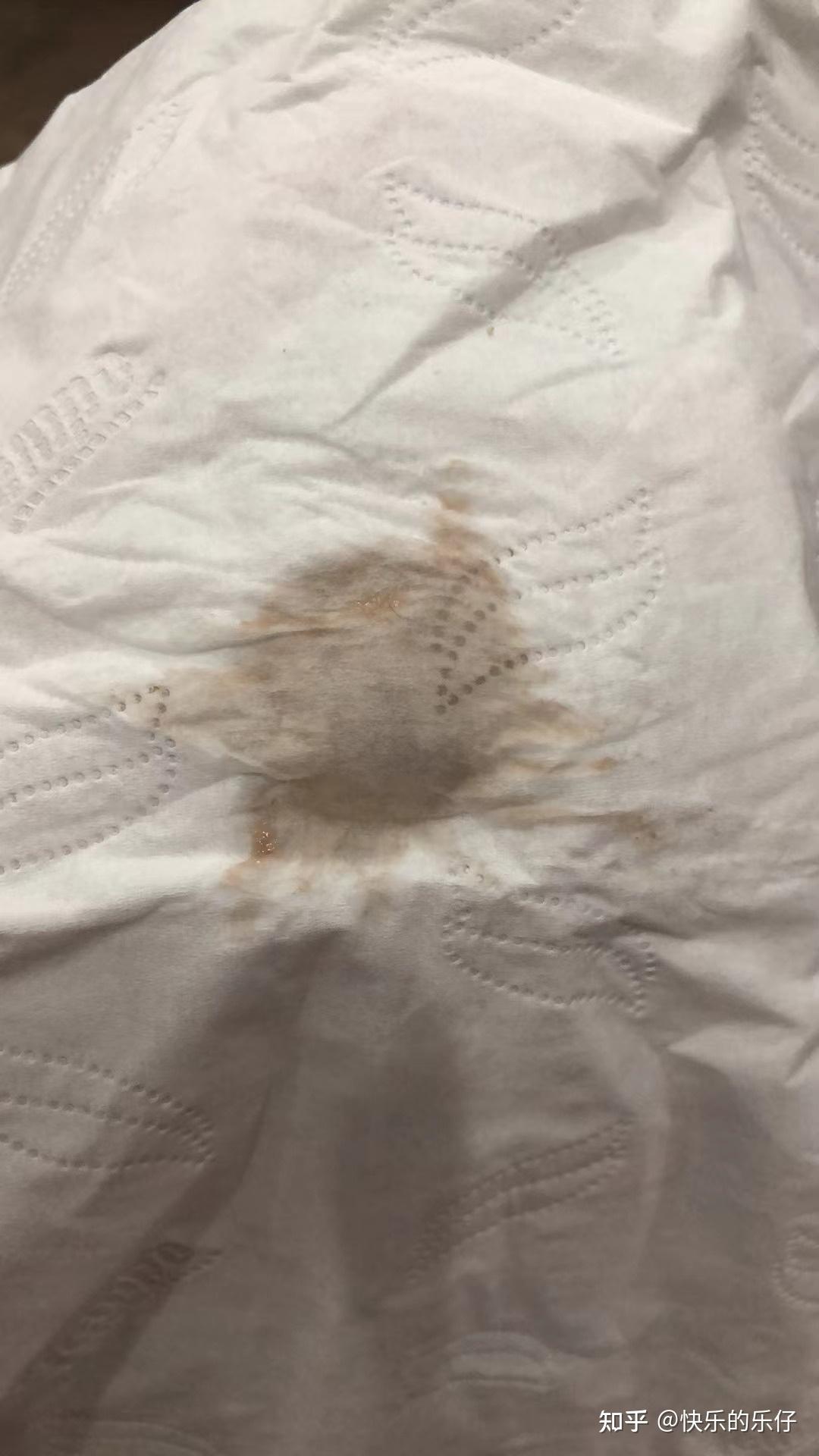 月经期间血呈现褐色,量很少不知道血还是什么,然后伴有块状和条线的