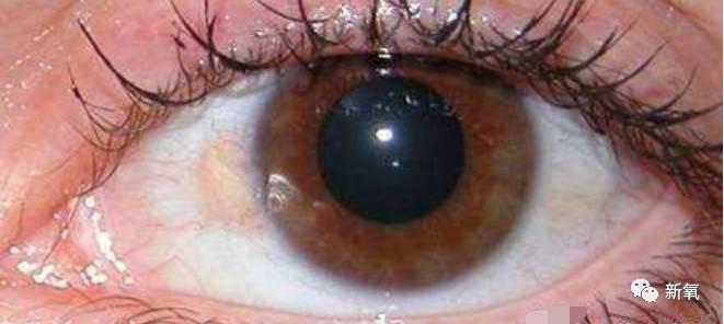 为什么有的人认真抗衰眼周一丝皱纹都没有却依然年龄