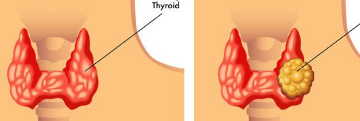 甲狀腺結節短期內迅速增大出現這些症狀小心甲狀腺癌南京新協和