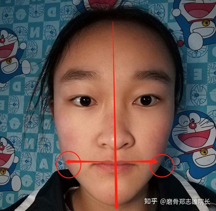 月亮脸还是鞋拔子脸?这可怎么办? - 知乎
