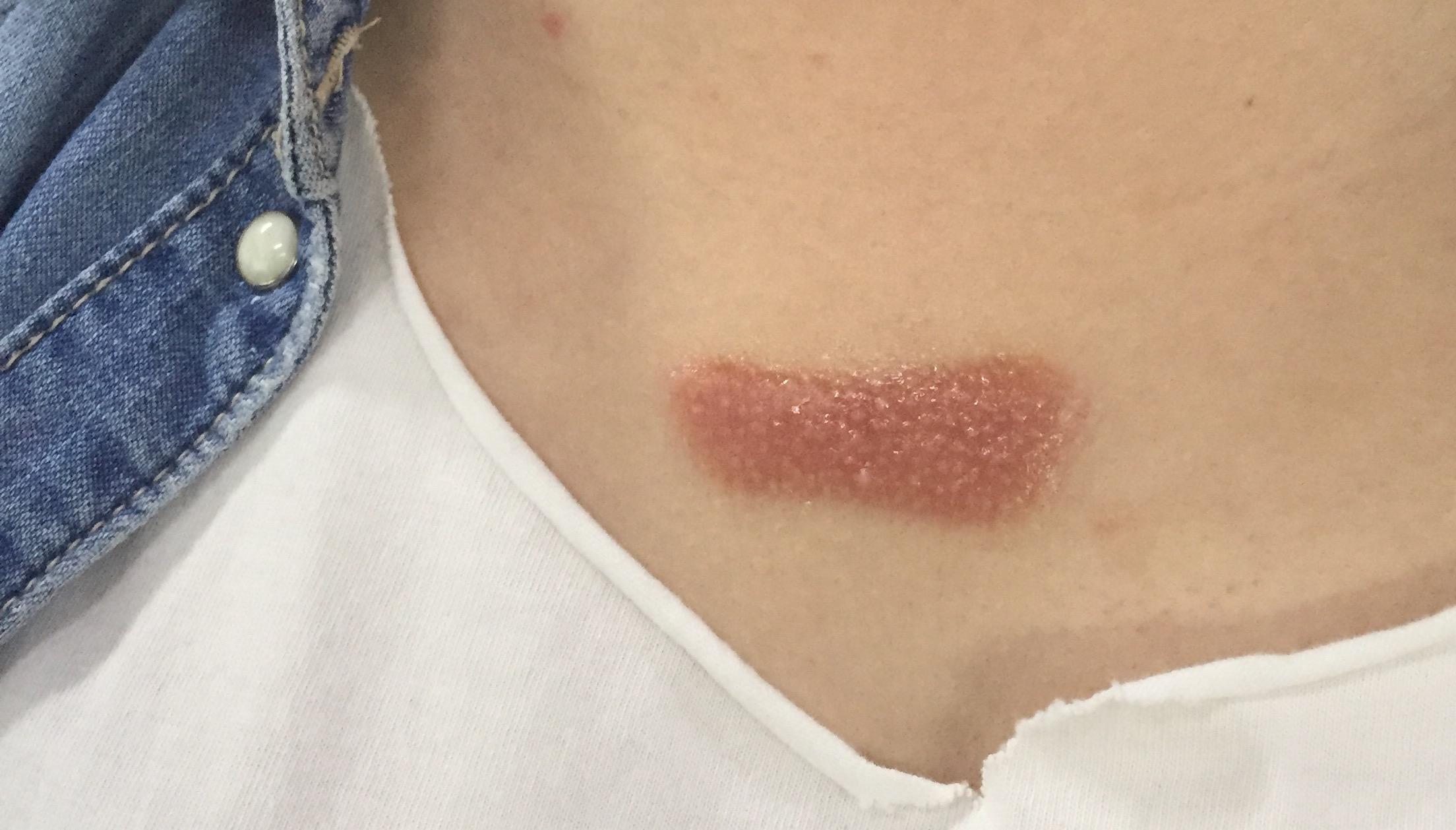 疤痕疙瘩到底怎么治能不能治好自己胸前长了一个增长速度越来越快应该