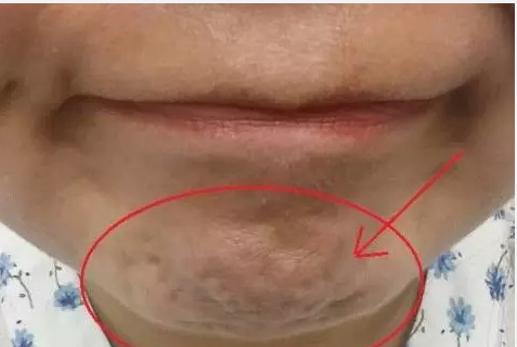 下巴凹凸不平?原来是这个原因!