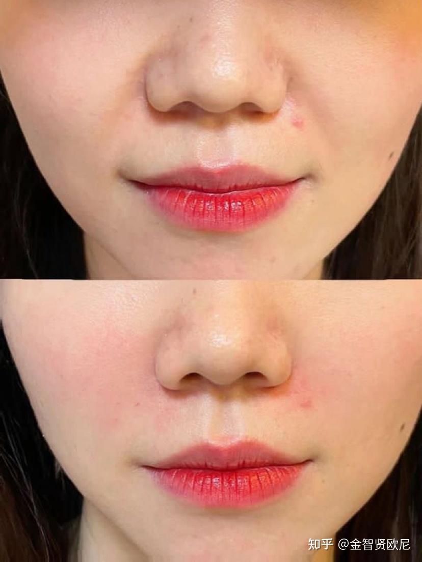 其实少女针打对了效果不是一般的好.