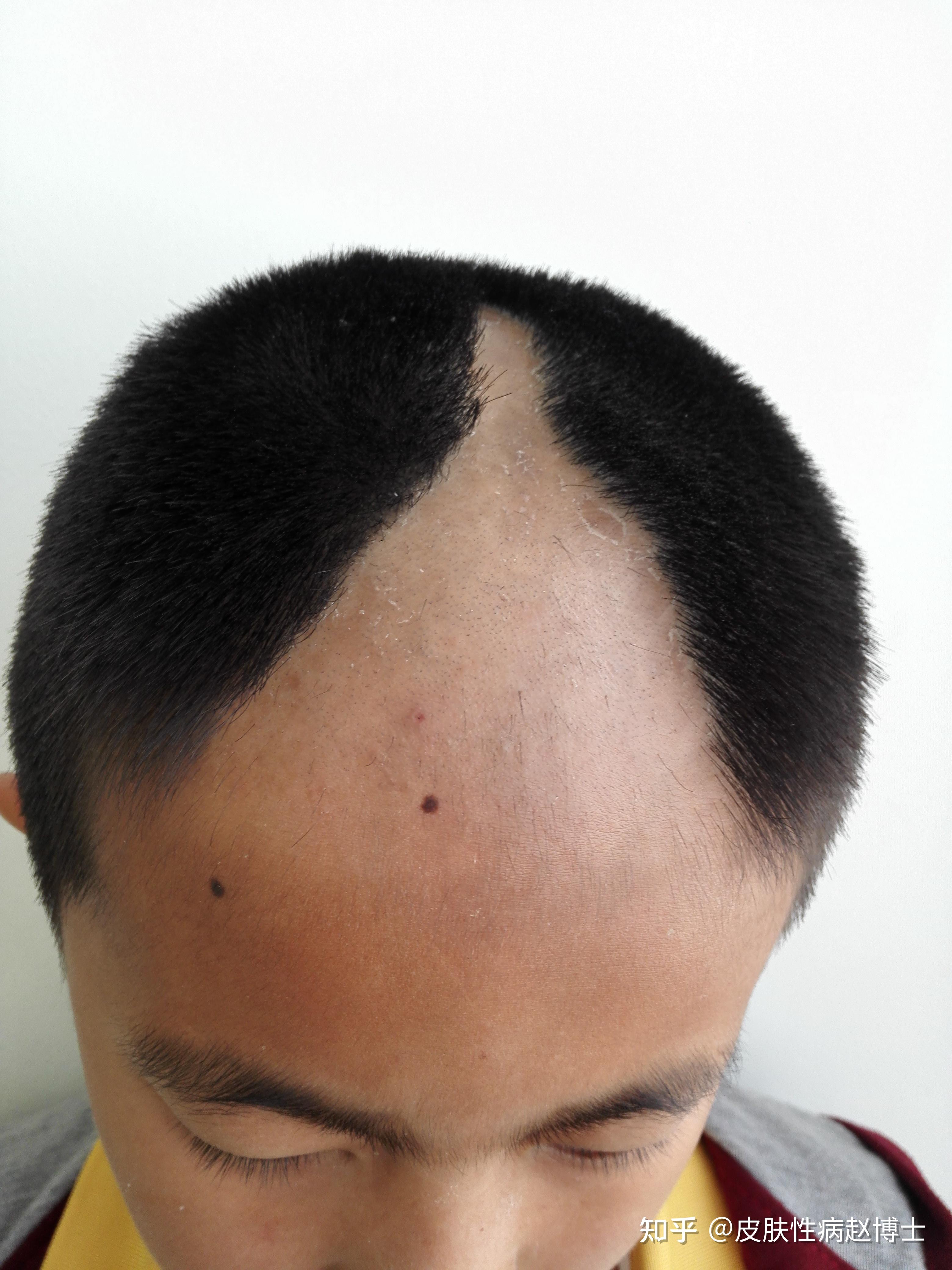 谁来拯救我拔毛癖的女儿我的女儿9岁,去年6月份得