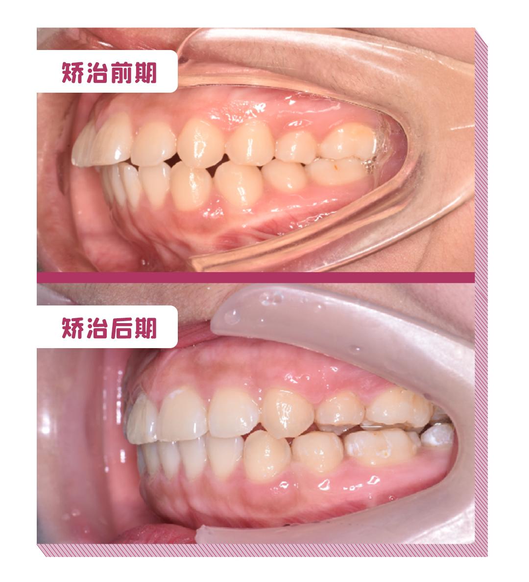 双颌突出图片图片