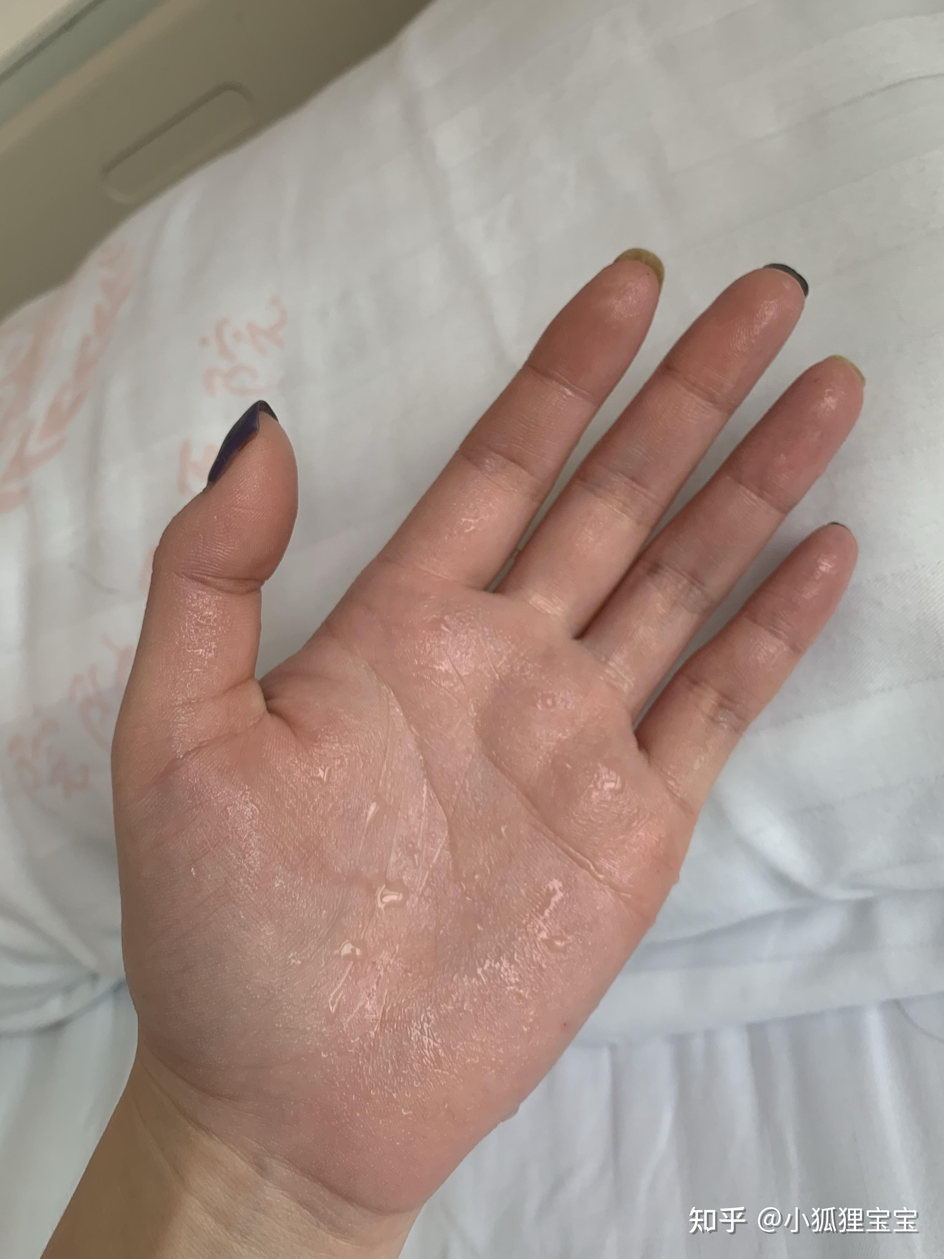 有没有手汗症超级严重的朋友怎么解决的