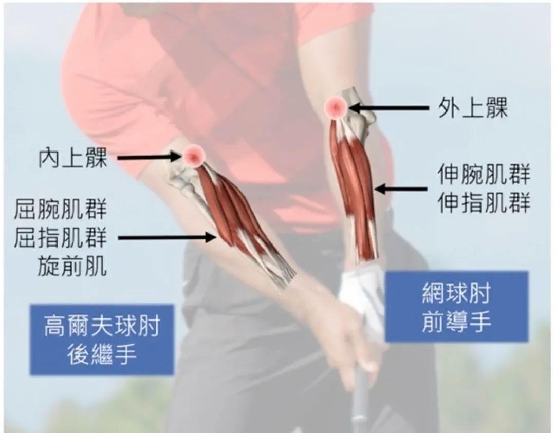 针对高尔夫球所造成的手腕部位运动伤害,我们可以依不同的身体构造来