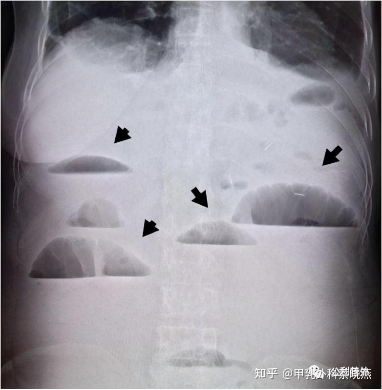 名医专访上海公利医院普外科吕强肠梗阻那些事儿