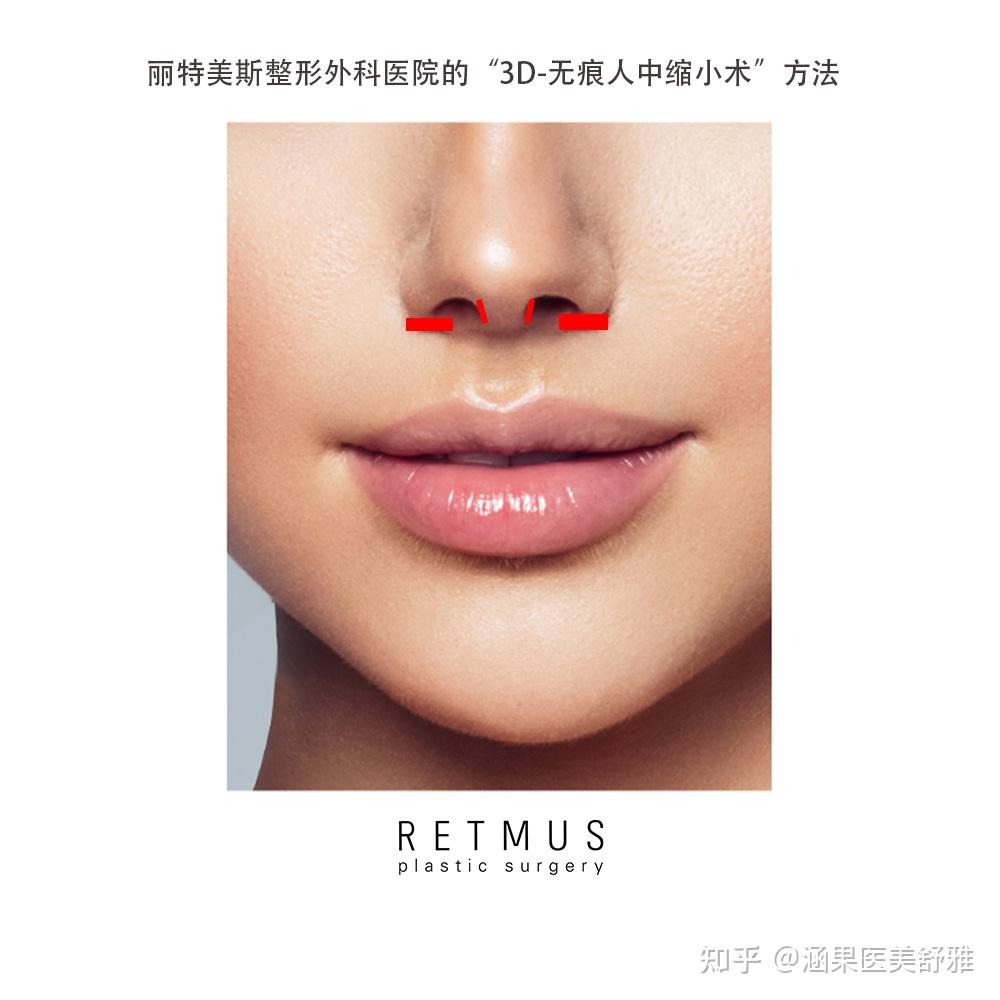 把人中中间部分(人中沟)提升,固定在上腭骨上,同时也把两侧鼻翼下方