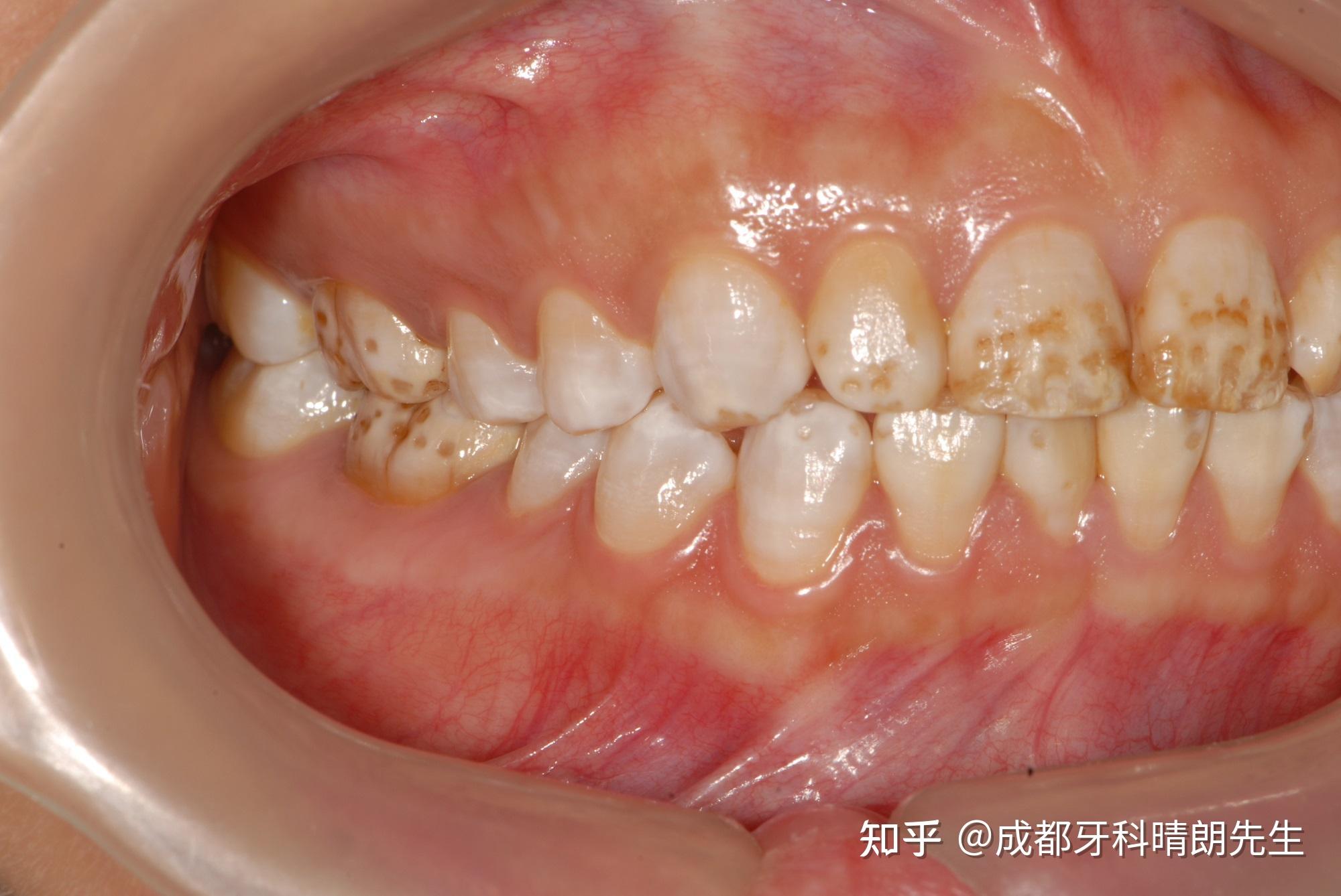 如何区分自己是四环素牙还是氟斑牙? 