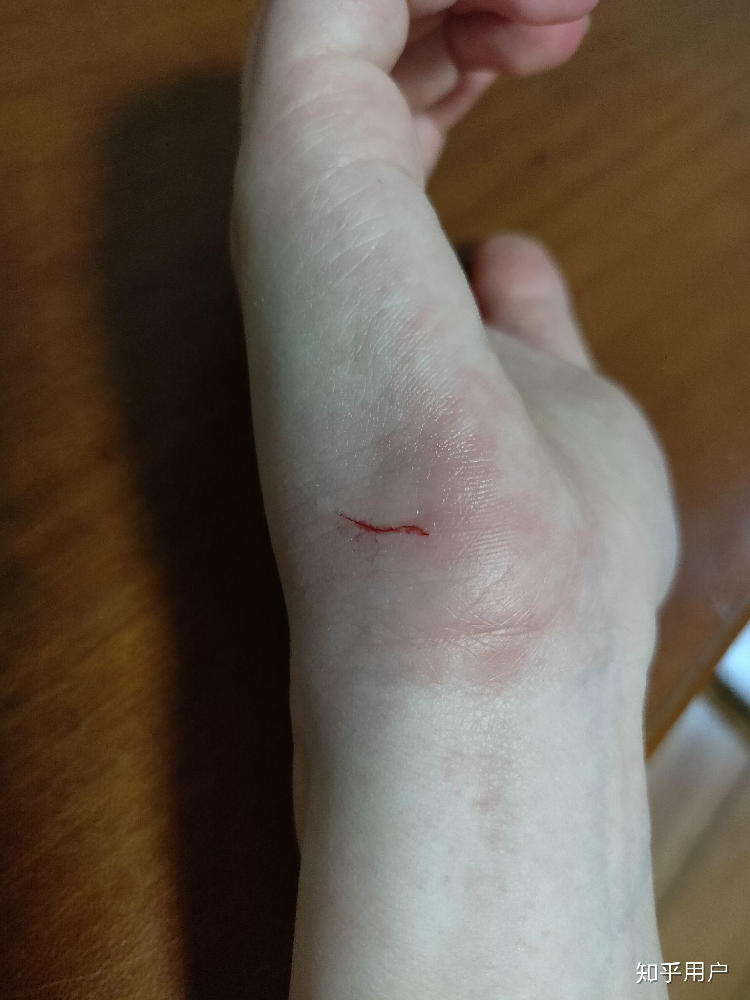 被猫抓流血了怎么办