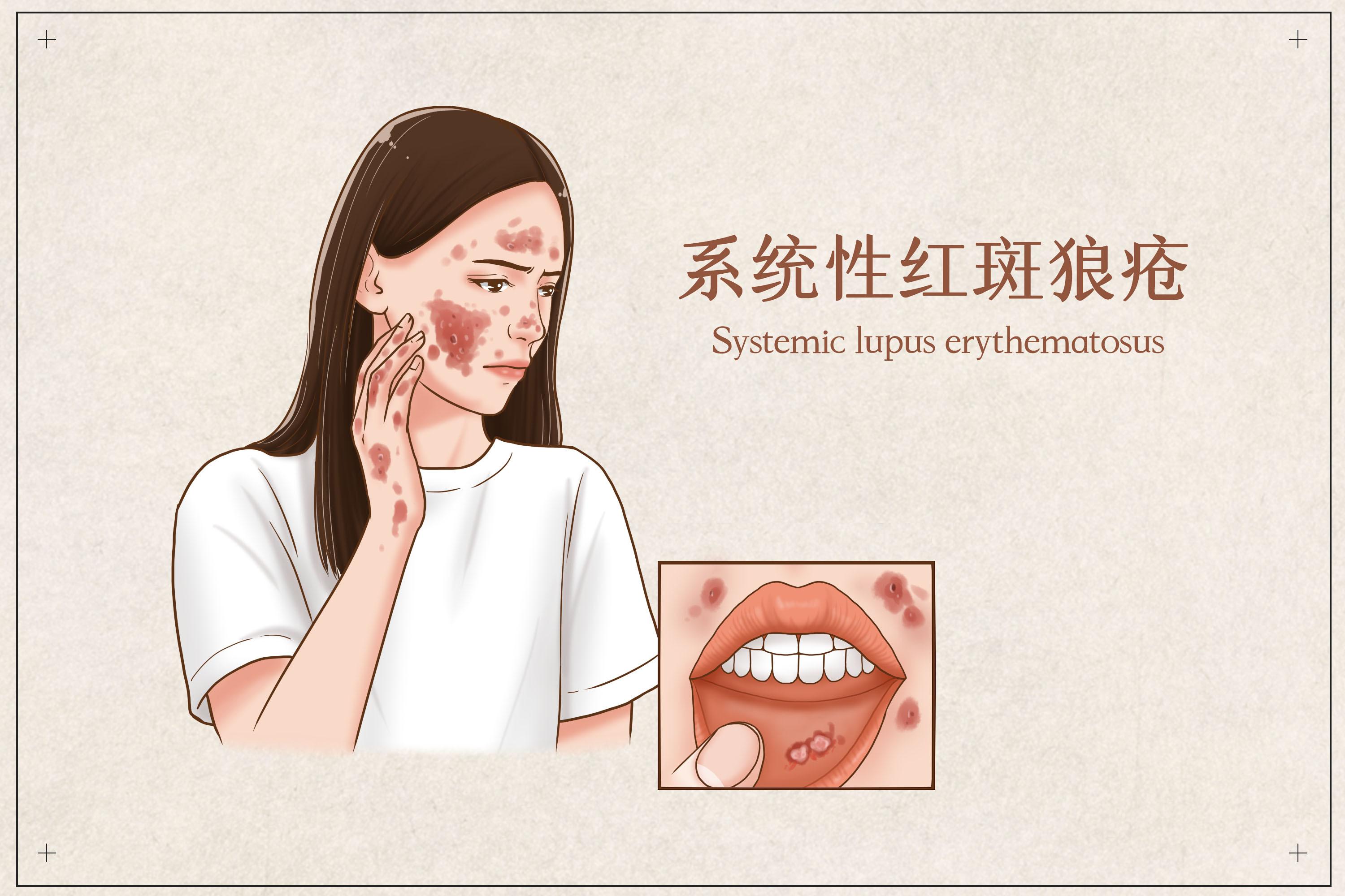 系统性红斑狼疮能治好吗? - 知乎