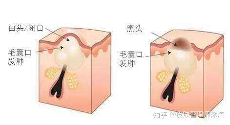 怎样才能不长闭口粉刺 v2-6105d8a233973a96426c70751f1ee308_r.jpg