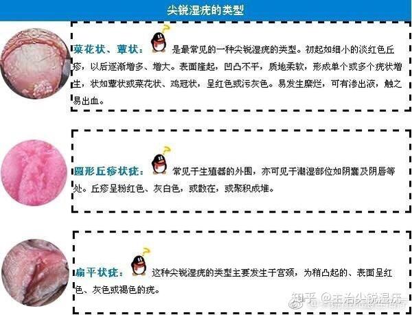 尖锐湿疣症状 - 知乎