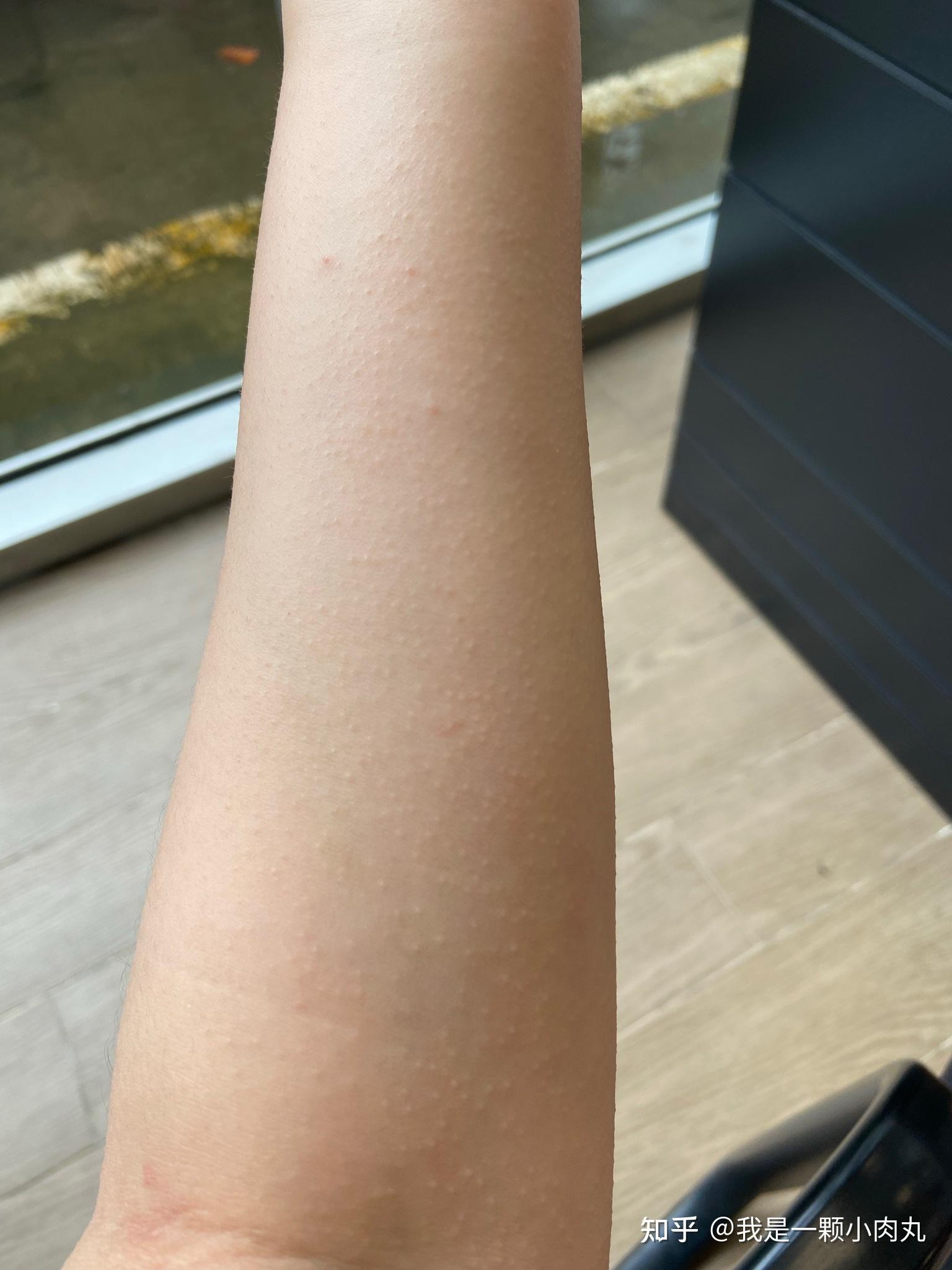 吃了异维a酸一个月后手上起红疹子刚开始长还不是特别严重但是有点