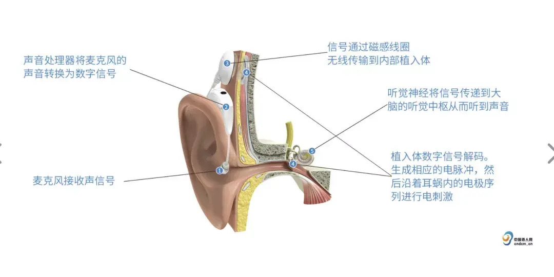 用电钻在颅骨表面磨出合适大小的骨槽,固定好植入设备;医生会在患者