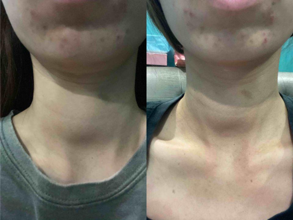 怎么样自己检查甲状腺 v2-6164e19bae49be8f448e13cea6c21e5c_1440w.jpg?source=172ae18b