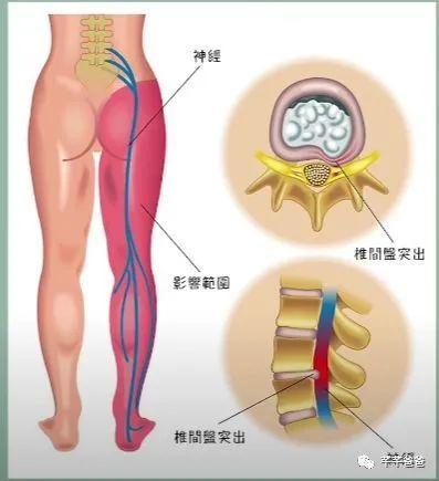 程序员腰突经历分享(中) 程序员腰突经历分享(中)