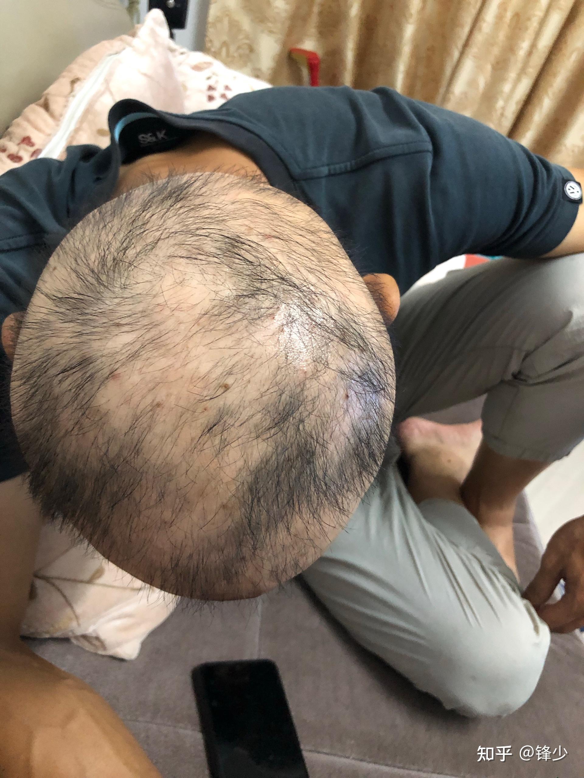 普秃3年正在治疗中