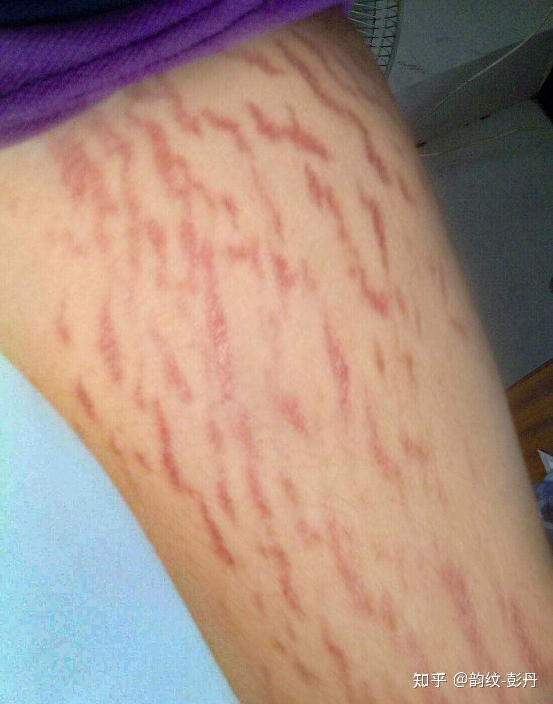 长肥胖纹是怎样一种体验?