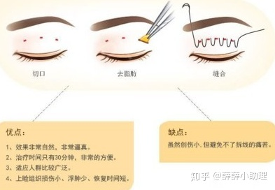 关于割双眼皮手术埋线微创全切怎么选形状怎么选择呢
