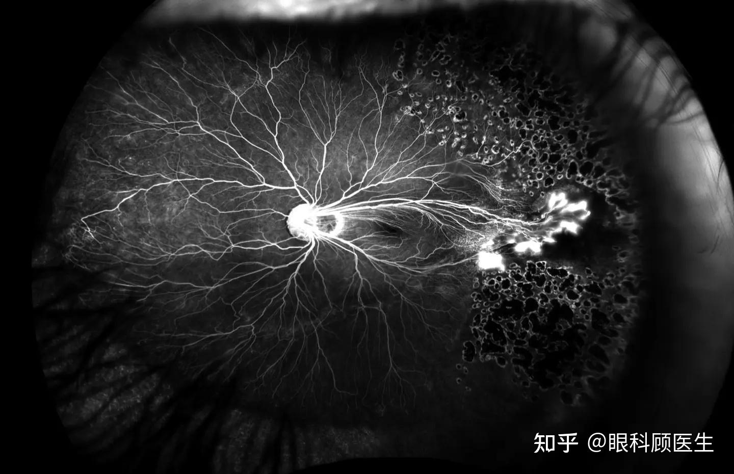 和trese将本病分为五期双眼家渗遗传特征本病可呈常染色体显性遗传,常