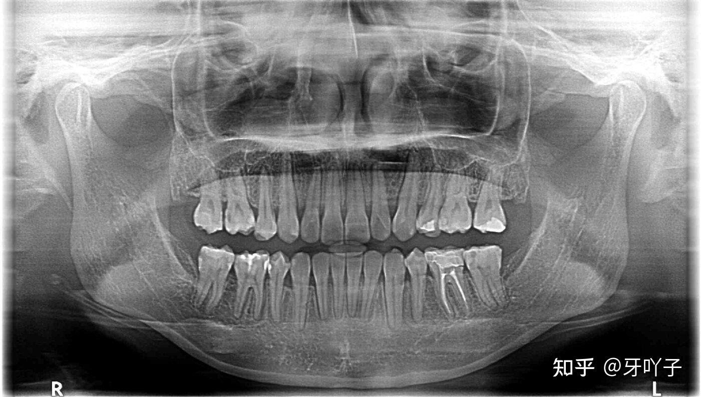 正常的牙齿侧面x片图片