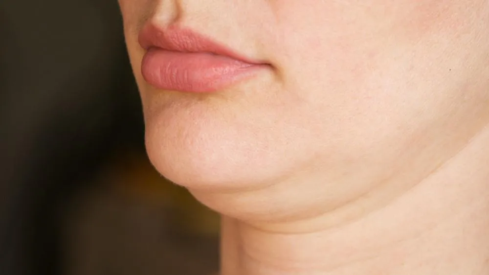 腮腺体面容下巴图片