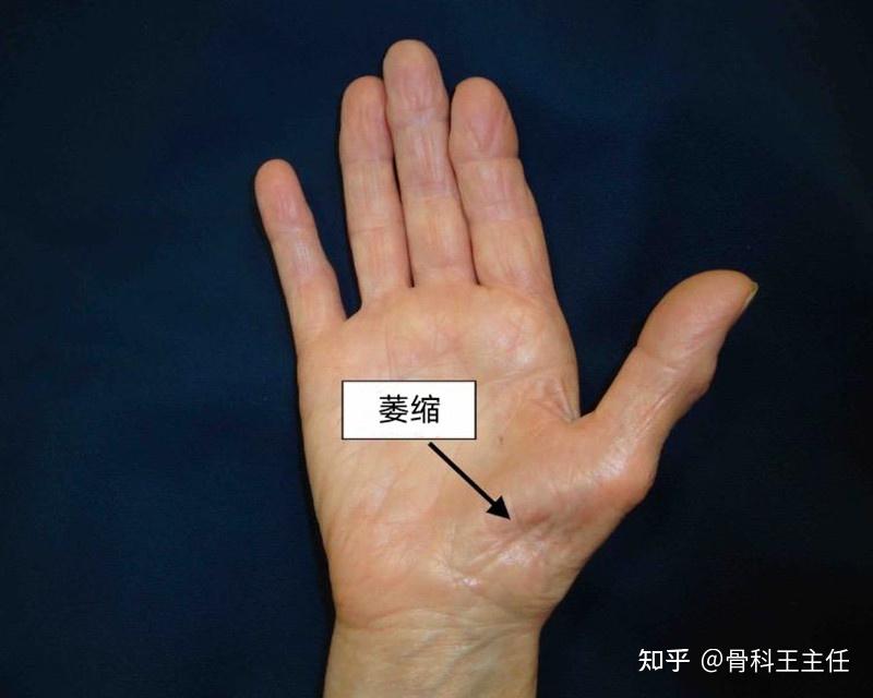 腕管综合征分轻度,中度,重度,都是什么感觉,又该怎么治? - 知乎