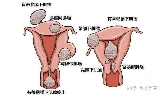 子宫肌层图图片