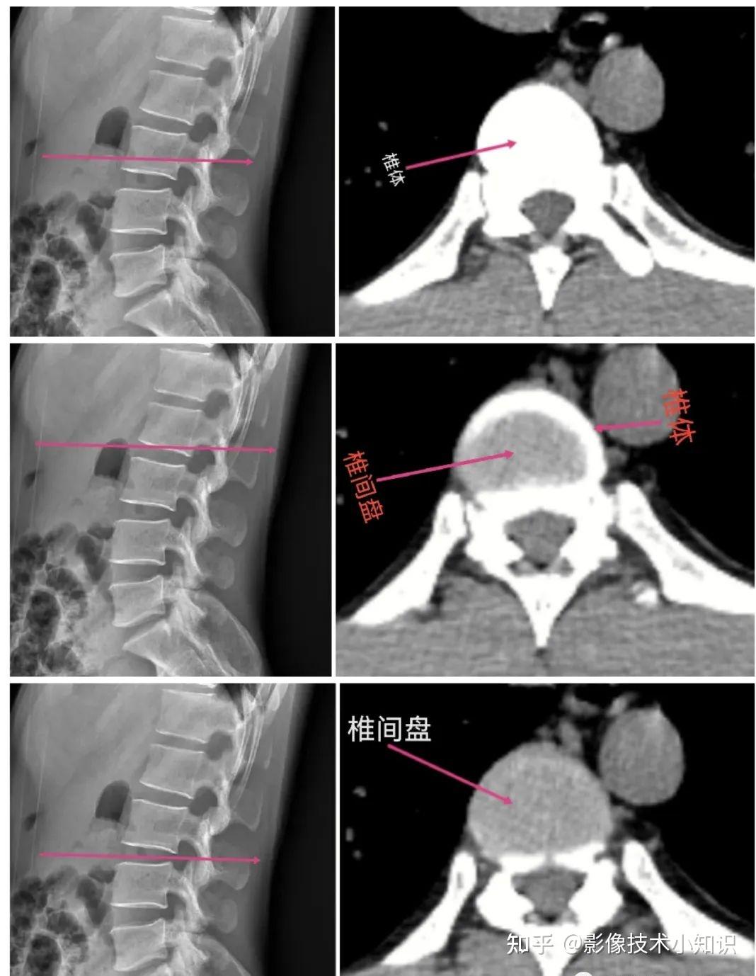 脊柱 | 弥漫性特发性骨质增生症（DISH）-MSK4_关节