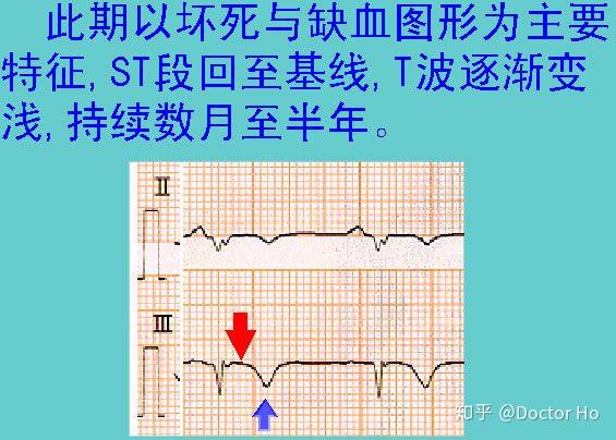 從而在心電圖上引起st-t的異常改變