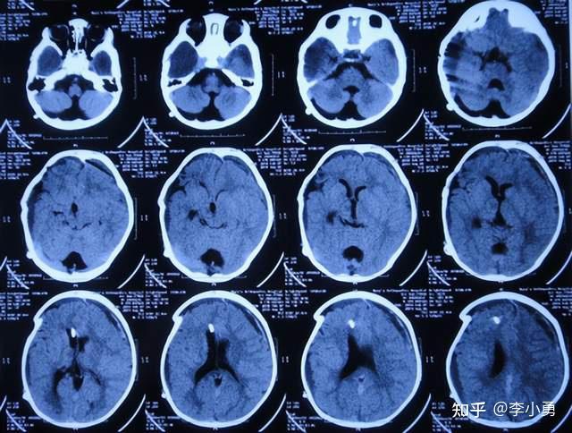 6月内4家医院双颞巨大蛛网膜囊肿术后变硬脑膜下积液,反复引流又成脑