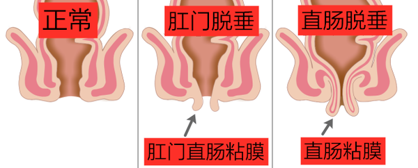 猫咪脱肛的原因和怎么办- 知乎