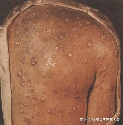 呈现出细小的皱纹,似卷烟纸样,此型有可能会进展成为皮肤t细胞淋巴瘤