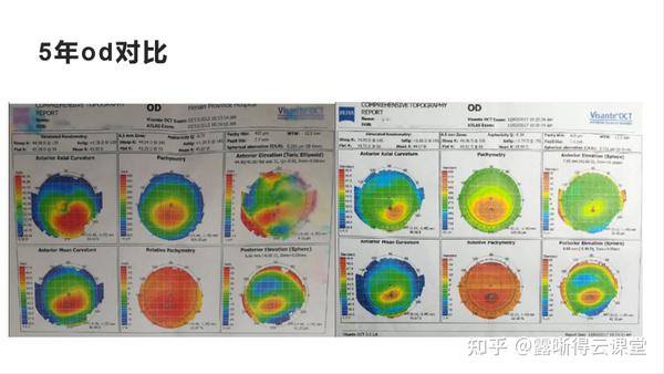 圆锥角膜的RGP验配及RGP临床效果分析（文字版） - 知乎