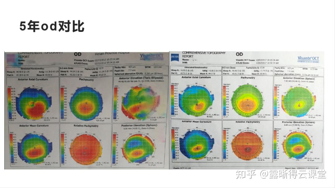 圆锥角膜的RGP验配及RGP临床效果分析（文字版） - 知乎