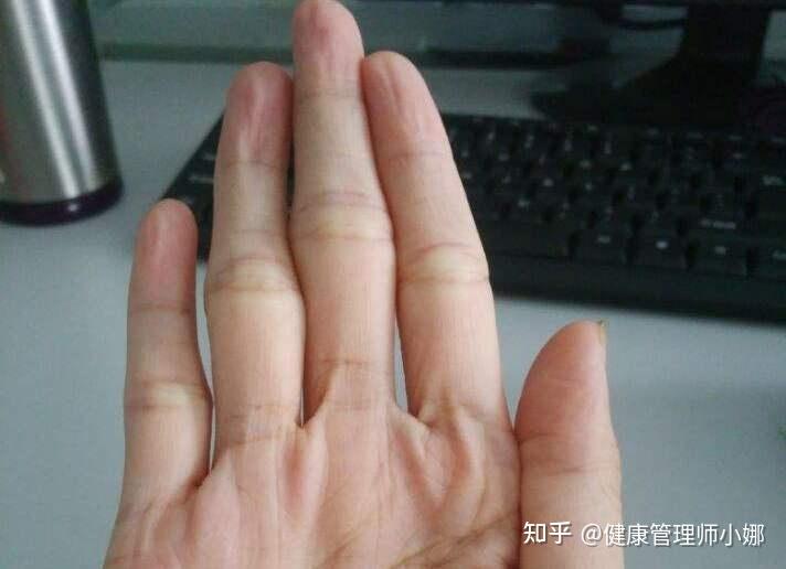 手掌正常吗,是不是肝掌? - 知乎