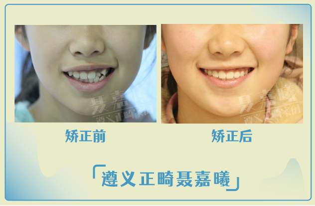 遵义牙齿矫正丨拥有完美的笑线，对颜值的影响有多大？ - 知乎