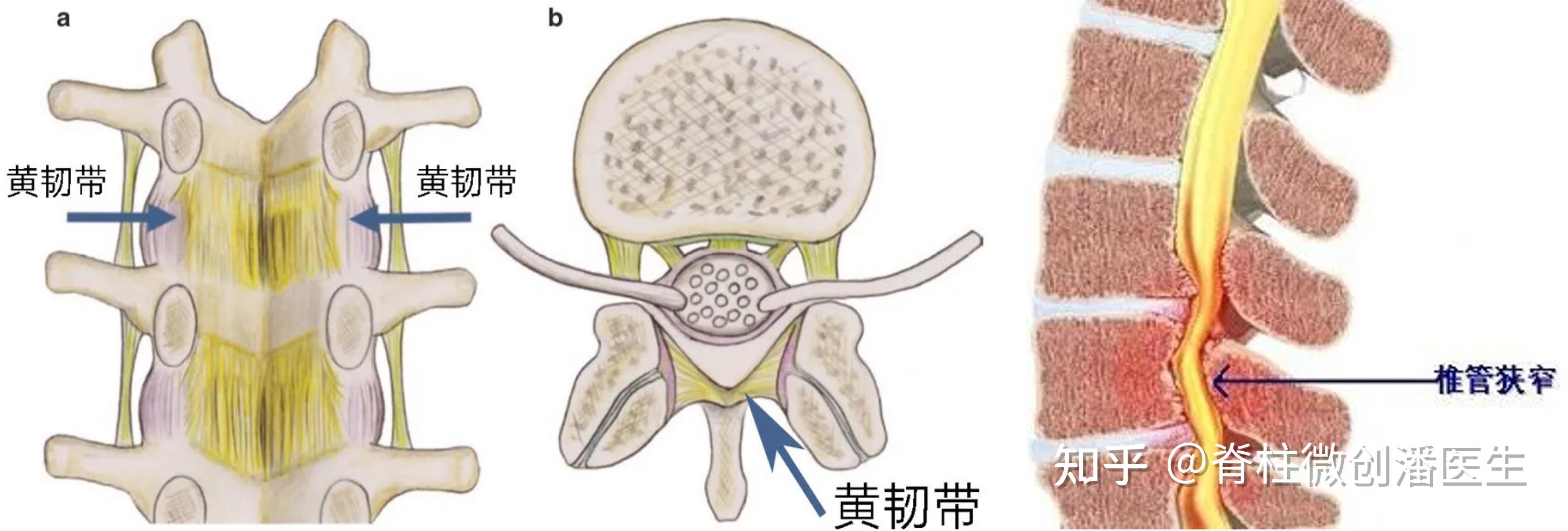 胸部束缚感、行走不稳——小心胸椎黄韧带骨化症 - 知乎