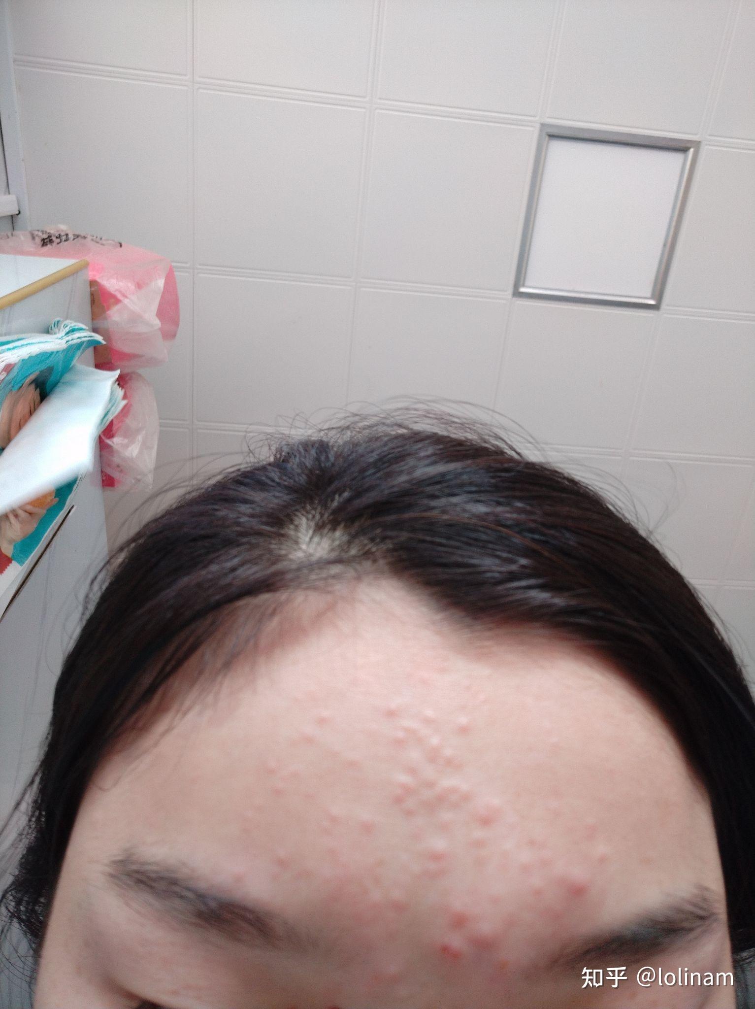 这种是闭口吗?(有图片)? - 知乎