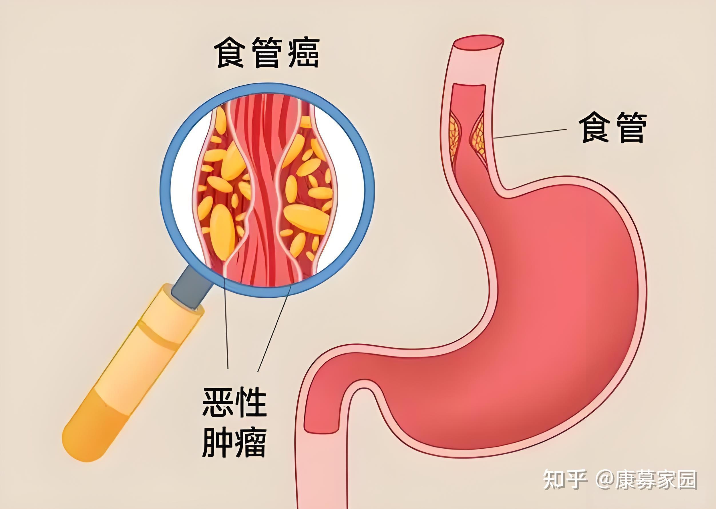 食道癌长在什么部位图图片