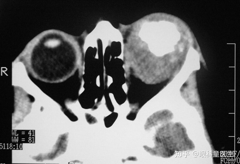 视网膜肿瘤性疾病